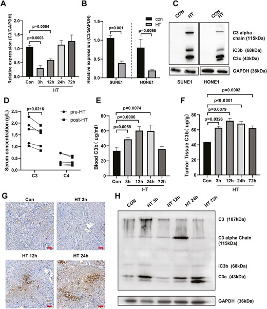 Hyperthermia decreases the mRNA expression of complement C3 but promotes enrichment of circulating C3 in NPC tumor. (A) SUNE1 cells were cultured at 37°C (con) or 43°C (hyperthermia heat therapy, HT) with 5% CO2 in a humidified incubator for 2 h. Then cells were continued to culture under 37°C with 5% CO2 in a humidified incubator for different time. The C3 mRNA levels were examined at different time points post-hyperthermia by qPCR. (B) SUNE1 and HONE1 cells were cultured at 37°C (con) or 43°C (HT) with 5% CO2 in a humidified incubator for 2 h and then cells were continued to culture under 37°C with 5% CO2 in a humidified incubator for 3 h. The C3 mRNA levels were examined in SUNE1 and HONE1 cells post-hyperthermia by qPCR. (C) Heat therapy-treated SUNE1 or HONE1 cells were cultured with sera from NPC patients for 24 h. Western blot was performed to examine the C3 complement and its sequential fragments in SUNE1 or HONE1 cells. GAPDH was used as an internal loading control. (D) Serum concentration of complement C3 and C4 in NPC patient pre- or 1-week post-hyperthermia was analyzed by ELISA assay. (E–H) SUNE1 cells were inoculated into nude mice to establish the NPC xenograft tumor model. SUNE1 tumor-bearing mice underwent heat therapy with 43°C water bath for 30 min and blood/tumor samples were collected at different time points post-HT for analysis. (E) Blood and (F) tumor C3b levels were analyzed by ELISA. (G) Tumor C3 levels were analyzed by IHC staining. Scare bar 50 μm. (H) The protein expression levels of C3, C3a, iC3b, and C3c in tumors were analyzed by western blot. GAPDH was used as an internal loading control. *P < 0.05, **P < 0.01, ***P < 0.001.
