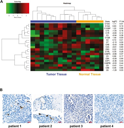 Public database analysis of complement expression in NPC. (A) Bioinformatics analysis was performed using the GSE61218 data set and heatmap showed the complement gene expression in NPC tumor tissues and normal tissues. (B) C3 IHC staining was performed using tumor specimen from NPC patients. Scare bar 20 μm. *P < 0.05.