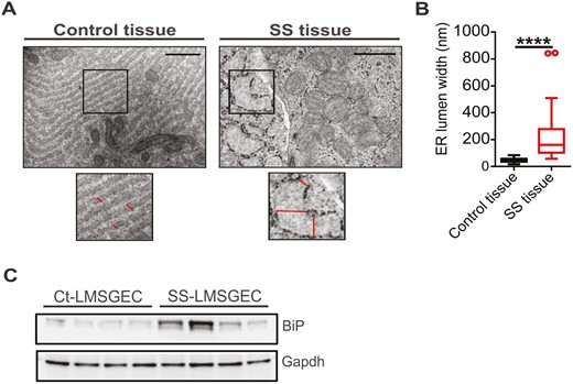 Activated ER in LMSGEC of SS patients. (A) Representative electron micrographs of SG sections from Cts and SS patients. Enlarged panels depict, at higher magnification, areas of rough endoplasmic reticulum shown in black boxes. Lines indicate the ER lumen width of LMSGEC. Scale bars; 1 μm and 500 nm for Ct- and SS-tissue, respectively. (B) Quantification of ER lumen width. Values show the median (horizontal line), interquartile range (IQR; box), and whiskers extending to the highest and lowest values, excluding outliers (>1.5*IQR; open circles). The measurements are from n = 4 subjects for each group. ****P < 0.0001 by Mann–Whitney test. (C) Western blot for analysis of GRP78/BiP expression in cell lysates of LMSGEC derived from Cts (n = 4) and SS patients (n = 4). Glyceraldehyde 3-phosphate dehydrogenase (GAPDH) was used as loading control