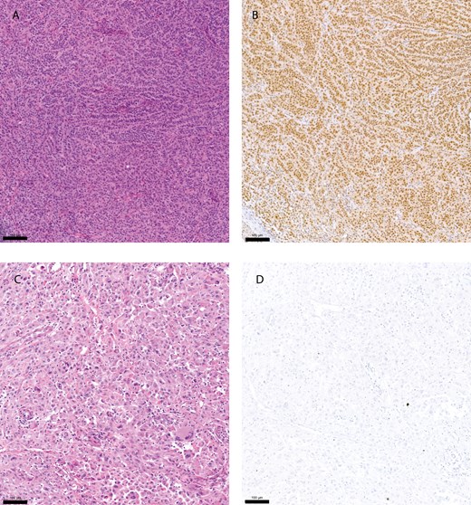 pSMAD2 immunohistochemistry staining. Hematoxylin and eosin (H&E) stain of a primary melanoma tumor sample (A), and corresponding sample with a positive immunohistochemistry (IHC) staining using a pSMAD2 antibody (B). (C and D) showing an H&E stain of a small intestine melanoma metastasis and corresponding negative IHC staining using a pSMAD2 antibody. Yardstick represents 100 µm