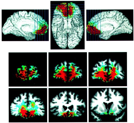 Overlap of lesions in the VM patients (n = 13). Red indicates an overlap of four or more patients.