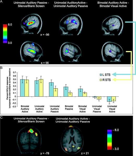 Auditory fMRI results. (A) BOLD response increases across three contrasts. Upper images are sagittal views of the left hemisphere (x = −56 for all images); lower images are of the right hemisphere (x = 56 for all images). Auditory passive minus baseline (left) shows widespread bilateral auditory activity. Auditory active minus passive (middle) shows posterolateral peaks (right STG; bilateral STS). Bimodal auditory active minus bimodal visual active (right) demonstrates bilateral peaks lateral and posterior to Heschl's gyrus along the STS. (B) Trend of decreasing relevance of auditory modality (left to right) and decreasing percent BOLD response in two voxels of interest in STS. (C) Decreases in BOLD response, crossmodal suppression, across two unimodal contrasts. Auditory passive minus baseline (left) shows decreased activity in right precuneus and right superior occipital gyrus. Unimodal auditory active minus passive (right) shows decreased activity in right inferior parietal lobe and right precuneus. See Table 2 for all coordinates. STG, superior temporal gyrys; STS, superior temporal sulcus.