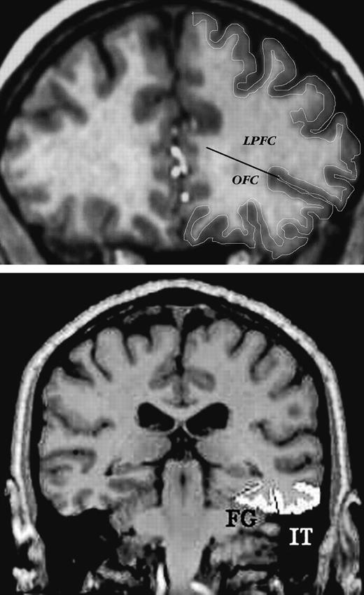 Examples of ROI demarcation on typical slices of MR images. Top panel: lateral prefrontal cortex, and orbito-frontal cortex, with a line indicating separation between the two. Bottom panel: inferior temporal (IT) and fusiform (FG) cortices.