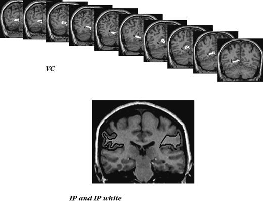 Examples of ROI demarcation in the posterior cortex. Top panel: a series of slices with traced primary visual cortex (VC). Bottom panel: a typical slice with inferior parietal lobule (IP) and inferior parietal white matter (IPw) traced.