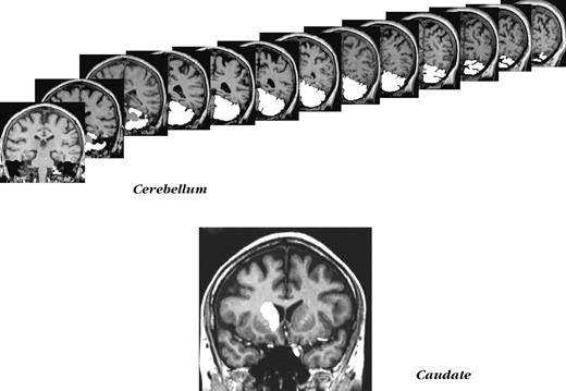 Examples of non-cortical ROIs demarcation. Top panel: a series of slices used in measuring cerebellar volume. Bottom panel: a typical slice with the caudate nucleus outlined.