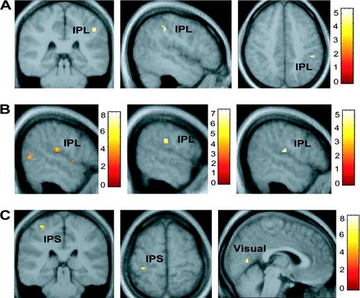 Visual spatial disengagement. (A) Images showing the inferior parietal lobule (IPL) regression with the cue cost score (disengagement) collapsed across all three conditions (WIN, LOSE and NEUTRAL) in the group random effects analysis thresholded at P < 0.001. (B) From left to right, regression CCs with BOLD signal showing activations in the inferior parietal lobule in WIN + LOSE − NEUTRAL (thresholded at P < 0.005), WIN − NEUTRAL (threshold at P = 0.001), and LOSE − NEUTRAL (threshold at P < 0.001) conditions. (C) Activation in the intraparietal sulcus (IPS), and visual cortex in WIN + LOSE − NEUTRAL. Color bars represent t-values.