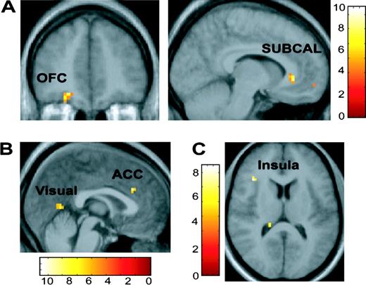 Valence-specific attentional modulatory effects. (A) From left to right: coronal and sagittal images depict activation in the orbitofrontal cortex (OFC) and subcallosal region (SUBCAL) preferentially associated with degree of visual bias (indexed by the comparison of the regression of WIN > LOSE with the cue benefit score -CBs) during the possibility of winning compared to losing money. (B) Sagittal section showing activation in the dorsal anterior cingulate cortex and visual cortex preferentially associated with degree of visual bias (indexed by the comparison of the regression of LOSE > WIN with the CBs) during the possibility of losing compared to wining money. (C) Axial section showing activity in the insula preferentially associated with the degree of disengagement (as indexed by a comparison of the regression of LOSE > WIN with the cue cost score CCs). All images thresholded at P < 0.001. Color bars represent t-values.