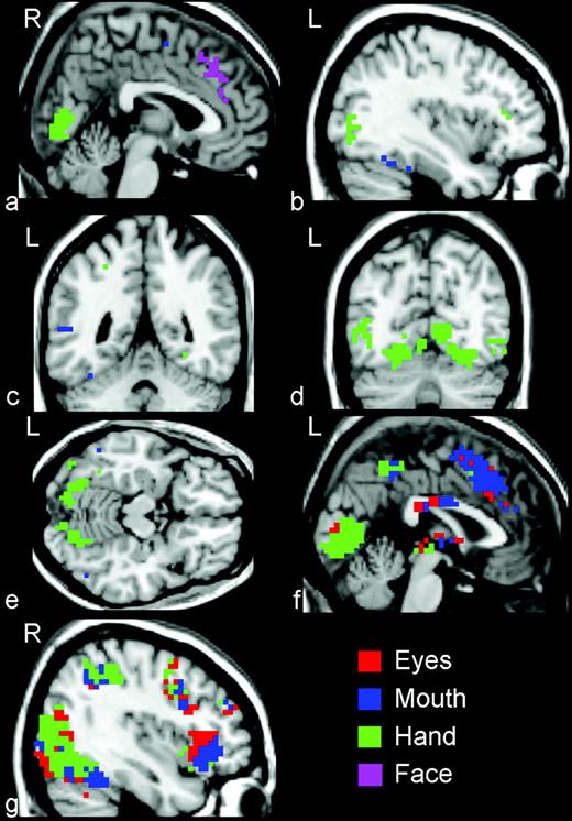 Activation maps indicating areas of activation outside of the STS region. In addition to activity in the STS region, other brain regions were activated by the viewing the three kinds of biological motion. These included (a, f) the right and left medial frontal gyrus and anterior cingulate cortex, (b, c, d) the fusiform and lingual gyri, (f) the thalamus and colliculi, and (g) inferior frontal gyrus, insula and superior parietal lobule.