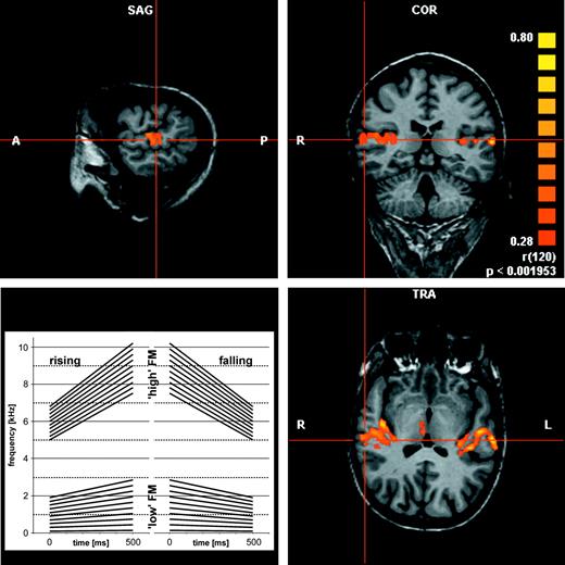 Three dimensional analysis of auditory cortex activation in an individual subject and set of FM stimuli used in experiment I.