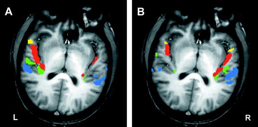 Patterns of auditory cortex activation in an individual subject in experiment I. (A) Uninformed listening, (B) categorization of FM direction. Significant activation (P < 0.05) is colour coded for each territory (TA yellow, T1 red, T2 green and T3 blue). Note the extreme lateralization contrast between (A) and (B).