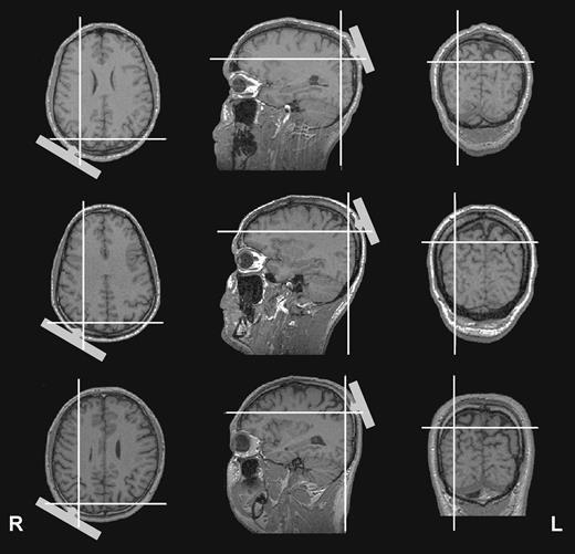 TMS sites relative to individual magnetic resonance images of three subjects as extrapolated using a frameless stereotaxic system. The cross-hairs highlight the cortical point located radially inward from the center of the coil (positioned on P4 of the 10–20 international electrode system). The figure suggests right dorsal PPC (around the intraparietal sulcus) as the site of TMS for all three exemplar subjects.