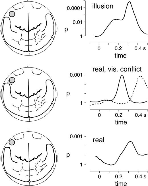 Comparison of GBA to illusory acoustic mismatch caused by an incongruent visual stimulus (top), to acoustic deviance in the presence of an incongruent visual stimulus (middle) and to purely auditory phonetic mismatch (bottom). The top left image shows the topography of the left inferior frontal sensor on a two-dimensional brain map with the major anatomical landmarks (seen from above, nose up), the top right graph depicts the time-course of the statistical difference in GBA at 77.5 ± 2 Hz between visual deviants and congruent audiovisual standards in the present study. The middle row depicts the topography and time-courses of GBA differences in the range of 75 ± 2 Hz between acoustic deviants and audiovisually congruent standards in the present study. The solid circle and line represent the activation during the first recording block, whereas the dashed circle and line depict the results during the second recording block. The bottom row shows topography and time course of activation in the frequency range of 86 ± 2.5 Hz for the processing of purely acoustic mismatch (deviant /ba/ versus standard /da/) in a previous study (Kaiser et al., 2002b).