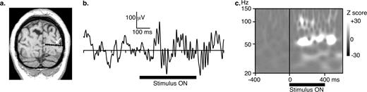 Large gamma oscillations from depth recordings in humans. (a) Depth multi-contact electrodes were inserted perpendicularly to the sagittal plane, at different locations in the visual extrastriate cortex. (b) Single trial at the electrode contact indicated by the arrow in (a). Large oscillations could be observed in raw data (0.1–200 Hz) at this recording site. (c) The power of these oscillations was quantified on a single trial basis in the time and frequency domain. Power was computed in the time (abscissa) and frequency (ordinate) domain and color-coded. Here, the light shade indicates a strong power at ∼60 Hz, from 100 to 500 ms after stimulus onset. To study the reactivity of each region in response to the stimulus, we normalized the power in each frequency band with respect to pre-stimulus onset (Z score, no unit) for each single trial. Time–frequency plots of Z-scores were then averaged across single trials. This allows induced activity, i.e. activity appearing with a jitter in latency from one trial to the next, to be studied.