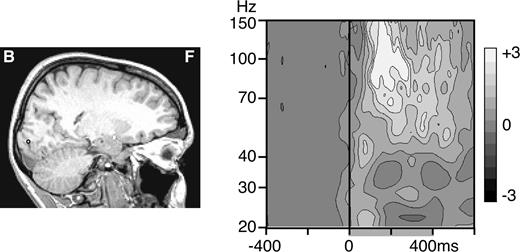 Gamma oscillations in the posterior calcarine region. A single contact in the vicinity of the calcarine sulcus (black circle on the MRI, left) displayed large gamma oscillations seen on the time-frequency plot of the mean Z-score (right). The peaking frequency of these oscillations was 74 Hz and their latency at half-height 152 ms. These values fall within the range observed in LO and the fusiform gyrus.