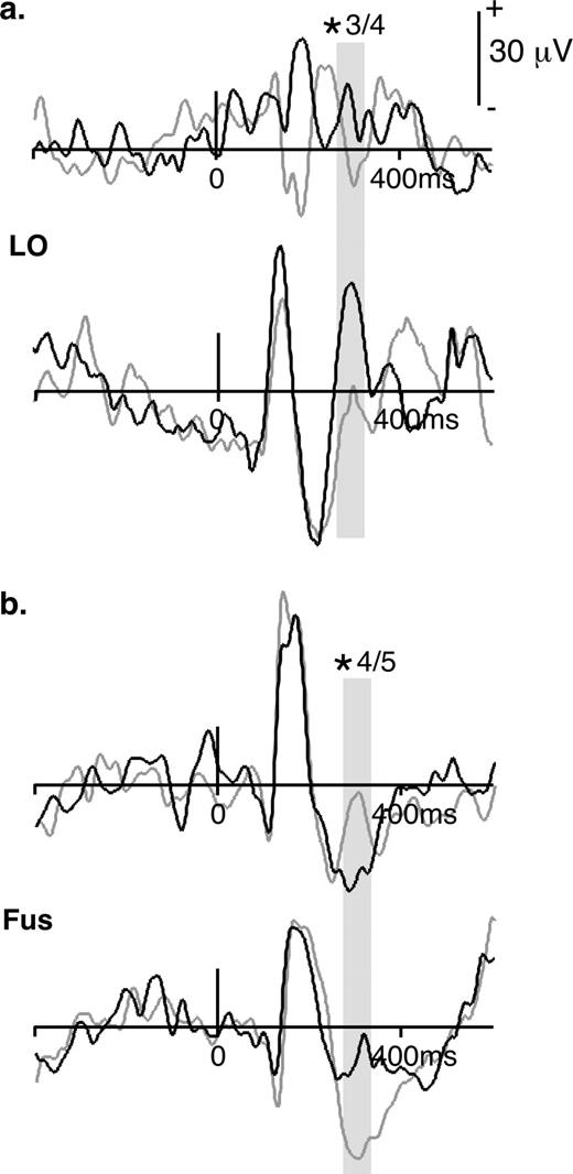 Evoked potentials in the attend (black lines) and unattend (gray lines) conditions. (a) In LO, the evoked response was barely visible in two patients (top, example of a weak response) or presented prominent peaks (bottom, example of a well-defined evoked potential). The mean amplitude around the third peak at 290 ms was significantly modulated by attention in three out of four patients (gray shading) with more positive values in the attend condition. (b) In the fusiform gyrus, evoked potentials showed peaks at 100, 180 and 300 ms. The third component at 300 ms was significantly modulated by attention in four out of five patients (gray shading), but the direction of modulation was not consistent across patients (more positive or more negative values in the attend condition, depending on the subject).