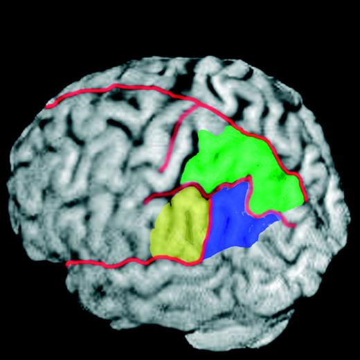 Major anatomical divisions of posterior parietal cortex in an individual subject. For purposes of localizing activations in individual subjects, boundaries between SPL (green), SMG (yellow) and ANG (purple) were determined on the basis of anatomical landmarks in each subjects' high-resolution, T1-weighted, anatomical MRI scan. This is necessary due to often substantial variations in cortical topography amongst subjects. Placement of borders between parietal and temporal and occipital lobes was based on Duvernoy (1991). Major sulci are drawn in red.