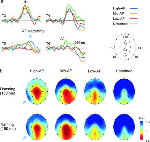The ERP correlate of AP as identified in the pitch-naming experiment: temporal (a) and spatial (b) characteristics. A unique left posterior temporal negativity, or AP negativity (blue arrow), was found in the High-AP group undertaking the Listening Task, peaking at 150 ms maximal at T5. AP negativity was distinguishable from the N1 component that peaked earlier, more anteriorly and more symmetrically (see T3 and T4 in a). Topographical maps illustrate the distribution of this component over left posterior temporal scalp (b, top). A similarly left-lateralized wave was also found in the Naming Task in the High-AP group (b, bottom).
