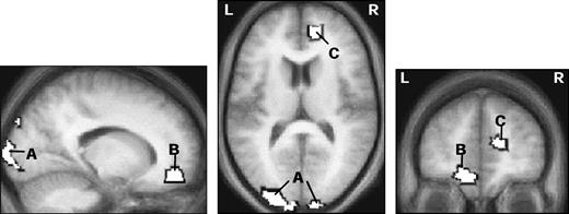 SPMs from whole-brain analysis of any brain areas showing a main effect of low minus high attentional load in the central task (all peaks P < 0.001). Greater activity during low load was found in bilateral occipital poles (A), as well as right pregenual cingulate (B) and left orbitofrontal cortex (C). Such decreases for high load occurred for all conditions of peripheral visual stimulation, but were greater for occipital regions in the presence of checkerboards [as shown by a significant interaction of load × stimulation (low minus high load with bilateral stimulation) > (low minus high load without stimulation) found in the same occipital areas; see text].