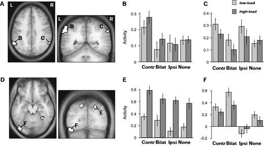 SPMs of brain areas showing decreased responses for bilateral compared to unilateral peripheral visual stimulation (all peaks P < 0.001). (A) Bilateral inferior parietal regions were more activated by unilateral stimuli in RVF than bilateral stimuli, regardless of load. (B) Average parameter estimates of activity (±SE) in the left inferior parietal cluster (shown in A; 203 voxels, mean x y z = −60 −52 40) for all conditions, showing selective response only to unilateral RVF stimuli. (C) Average parameter estimates of activity across the right inferior parietal cluster (shown in A; 58 voxels, mean x y z = 60 −55 40), showing selective response to either RVF or LVF unilateral stimuli, but not bilateral stimuli. (D) Areas showing an interaction between central load and unilateral minus bilateral peripheral stimulation. These include bilateral superior parietal and fusiform regions, where a decrease in the responses to bilateral versus unilateral stimulation was more pronounced during high attentional load. (E) Average parameter estimates of activity in the right superior parietal cluster (shown in D; 51 voxels, mean x y z = 20 −80 44), showing similar responses to bilateral and contralateral-unilateral stimuli during low, but not high load, in addition to general high load increases. The left superior parietal region showed a similar pattern. (F) Average parameter estimates of activity in the posterior left fusiform cluster (shown in D; 80 voxels, mean x y z = −42 −80 −19), showing enhanced responses during bilateral compared to unilateral stimulation during low, but not high load. The right fusiform showed a similar pattern. Same abbreviations as in Figure 2.