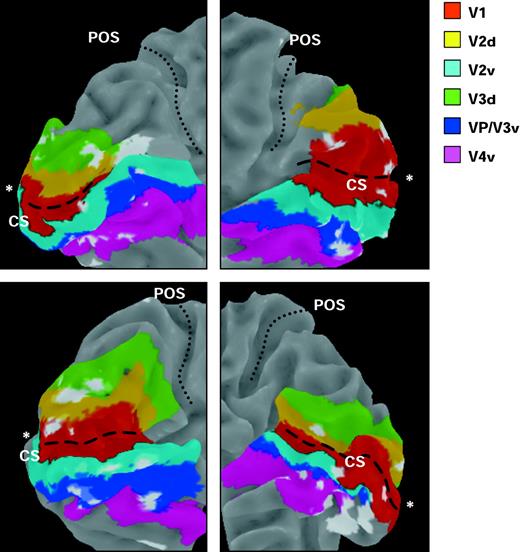 Three-dimensional reconstruction of medial occipital cortex where visual responses decreased during high versus low attentional load, in four representative participants (two left and two right hemispheres). Colored regions correspond to voxels that were assigned to distinct visual areas (V1, V2, V3, ventral V4) based on retinotopic mapping after cortical flattening. Regions colored in white correspond to clusters from individual SPMs (thresholded at P < 0.01) where significant decreases were found during high versus low central load, overlapped on the retinotopically mapped areas. These clusters were distributed across the different visual areas, including V1. Asterisks show the foveal region at the occipital pole. CS = calcarine sulcus; POS = parieto-occipital sulcus.