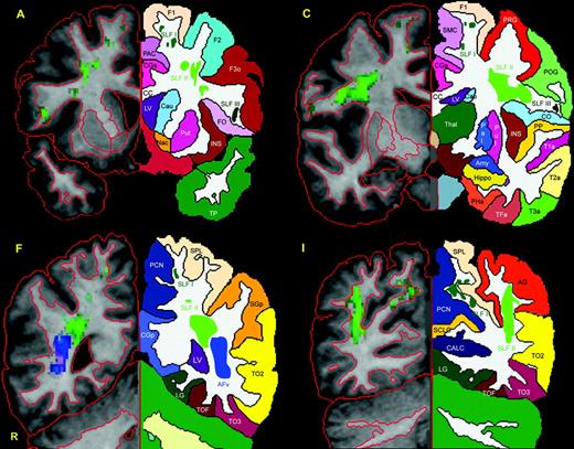 Four representative T1 coronal sections that correspond to four of the coronal slices included in Figure 1A, C, F and I are utilized to show the topographic anatomy and location of the four subcomponents of SLF, i.e. SLF I, SLF II, SLF III and AFv. To this end the individual brain was segmented and parcellated using the Center for Morphometric Analysis neuroanatomical framework (Filipek et al., 1994; Caviness et al., 1996). Thus the precise location of SLF I, SLF II, SLF III and AFv is indicated in relation to cortical and subcortical structures. On the left side of each panel (i.e. the radiological right side indicated as R) the contour outline of the cortical and subcortical structures is shown in red. On the opposite side of each panel the mirror images of the coronal section on the right are shown to demonstrate the parcellation of specific cortical and subcortical structures. Abbreviations: AFv, vertical part of arcuate fascicle; AG, angular gyrus; CALC, intracalcarine cortex; CC, corpus callosum; CGa, cingulate gyrus, anterior; CGp, cingulate gyrus, posterior; CN, cuneal cortex; CO, central operculum; F1, superior frontal gyrus; F2, middle frontal gyrus; F3o, inferior frontal gyrus, pars opercularis; F3t, inferior frontal gyrus, pars triangularis; FMC, frontal medial cortex; FO, frontal operculum; FOC, frontal orbital cortex; FP, frontal pole; H1, Heschl's gyrus; INS, insula; LG, lingual gyrus; OP, occipital pole; OF, occipital fusiform gyrus; OLi, lateral occipital cortex, inferior; OLs, lateral occipital cortex, superior; PAC, paracingulate cortex; PCN, precuneus; PHa, parahippocampal gyrus, anterior; PHp, parahippocampal gyrus, posterior; PO, parietal operculum; POG, postcentral gyrus; PP, planum polare; PRG, precentral gyrus; PT, planum temporale; SC, subcallosal cortex; SCLC, supracalcarine cortex; SGa, supramarginal gyrus, anterior; SGp, supramarginal gyrus, posterior; SLF, superior longitudinal fascicle; SMC, supplementary motor cortex; SPL, superior parietal lobule; T1a, superior temporal gyrus, anterior; T1p, superior temporal gyrus, posterior; T2a, middle temporal gyrus, anterior; T2p, middle temporal gyrus, posterior; T3a, inferior temporal gyrus, anterior; T3p, inferior temporal gyrus, posterior; TFa, temporal fusiform, anterior; TFp, temporal fusiform, posterior; TO2, middle temporal gyrus, temporooccipital; TO3, inferior temporal gyrus, temporooccipital; TOF, temporooccipital fusiform gyrus; TP, temporal pole; R, right.