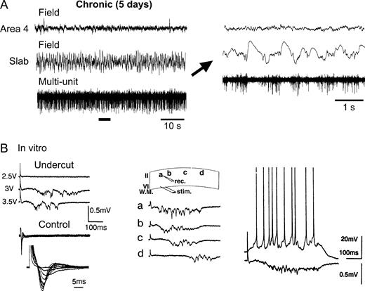 Spontaneous and evoked activities in chronically isolated cortex. (A) Field potentials and multi-unit recordings from the unanesthetized intact cortex and the chronically isolated slab on the fifth day after isolation during a period of REM sleep. The fragment indicated by the horizontal bar is expanded on the right as indicated by the arrow. The chronically isolated slab was characterized by slow waves and clustered neuronal firing. (B) Characteristics of epileptiform events recorded in slices of chronically isolated (‘undercut’) cortex [modified from Prince and Tseng (1993), used with permission]. Electrical stimulation evoked all-or-none polyphasic epileptiform field potentials in undercut cortex (left panel), but only short-latency responses in slices of contralateral control cortex. Burst discharges propagated across cortex at an average speed of 1–4 cm/s (middle panel). The distance between positions a–d was ∼5 mm. Intracellular recording of a layer 2 pyramidal cell during an evoked epileptiform event (right panel).