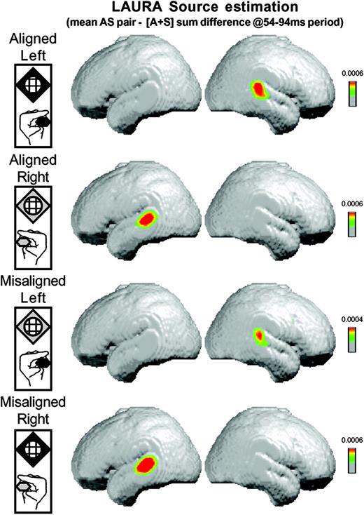 Results of the LAURA linear distributed inverse solution averaged across subjects for the difference between simultaneous auditory–somatosensory stimulation and the summed responses from the constituent unisensory conditions. For each AS stimulus combination (see insets on left), this source estimation revealed activity in the posterior superior temporal lobe contralateral to the hand of somatosensory stimulation (see text for full details).