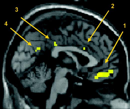 Influence of motor expertise on brain responses to action observation: saggital section showing activation after correction for multiple comparisons across the whole brain at P < 0.05. (1) ventro-medial frontopolar gyrus, (2) cingulate gyrus, (3) posterior cingulate gyrus and (4) retrosplenial gyrus.