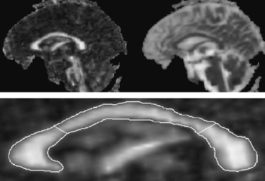 Top: full midsagittal FA (left) and <D> (right) image of a 61-year-old healthy man. Bottom: expanded midsagittal view of the FA image of the corpus callosum. The outline was manually drawn on the b = 0 image and superimposed onto the FA image for quantitation. Geometric lines divide the total corpus callosum into the genu (left), body (middle) and splenium (right).