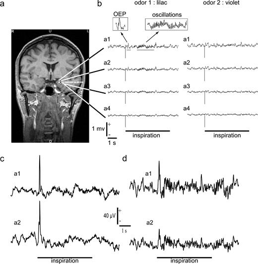 Example of electrophysiological recordings in three patients (Pt1, Pt2, Pt3) collected from the amygdalar nucleus. (a) Coronal MRI showing the electrode implanted in the left amygdala of Pt1. The four deepest contacts (a1, a2, a3, a4) were located inside the amygdala. Black contact: site of maximal energy of gamma oscillations induced by the odorants. (b) Raw monopolar recordings obtained after the presentation of two odorants of a pair (lilac and violet) in the amygdala of Pt1. The stimulus onset is at 0 ms (vertical bar). Horizontal bar: duration of stimulus presentation used for statistical analyses. The two enlarged boxes show the OEPs and the subsequent oscillatory response. (c) Raw monopolar recordings obtained after the presentation of one odorant of a pair in the amygdala of Pt2. Responses in the two deepest contacts are shown (a1, a2). Horizontal bar: duration of stimulus presentation used for statistical analyses. (d) Raw monopolar recordings obtained after the presentation of one odorant of a pair in the amygdala of Pt3. Responses in the two deepest contacts are shown (a1, a2). Horizontal bar: duration of stimulus presentation used for statistical analyses.