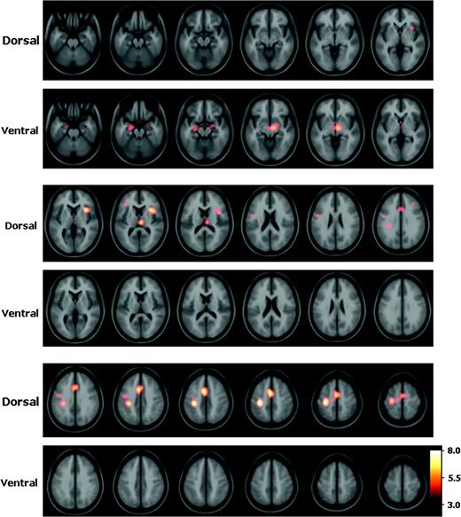 Coactivation patterns of dorsal versus ventral striatum. Statistical peaks (in hot-metal color) of brain areas coactivated with the dorsal versus ventral striatum superimposed upon the ICBM152 MRI (see text for details). Color bar indicates degree of statistical significance (t statistic). Axial sections are spaced 5 mm apart and start at z = −25.