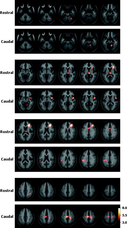 Coactivation patterns of rostral versus caudal putamen. Statistical peaks (in hot-metal color) of brain areas coactivated with the rostral versus caudal putamen superimposed upon the ICBM152 MRI (see text for details). Color bar indicates degree of statistical significance (t statistic). Axial sections are spaced 5 mm apart and start at z = −35.