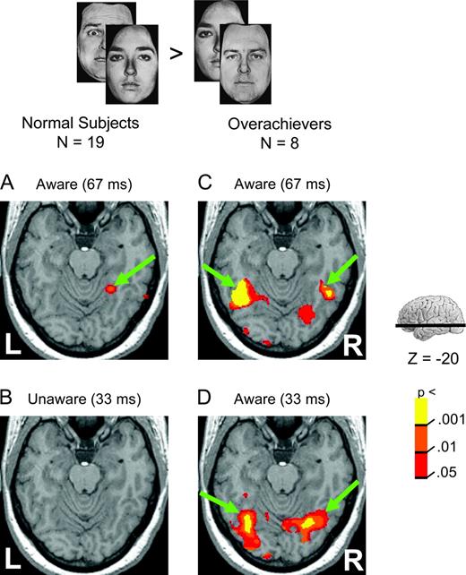 Fusiform gyrus responses to fearful faces as a function of ...
