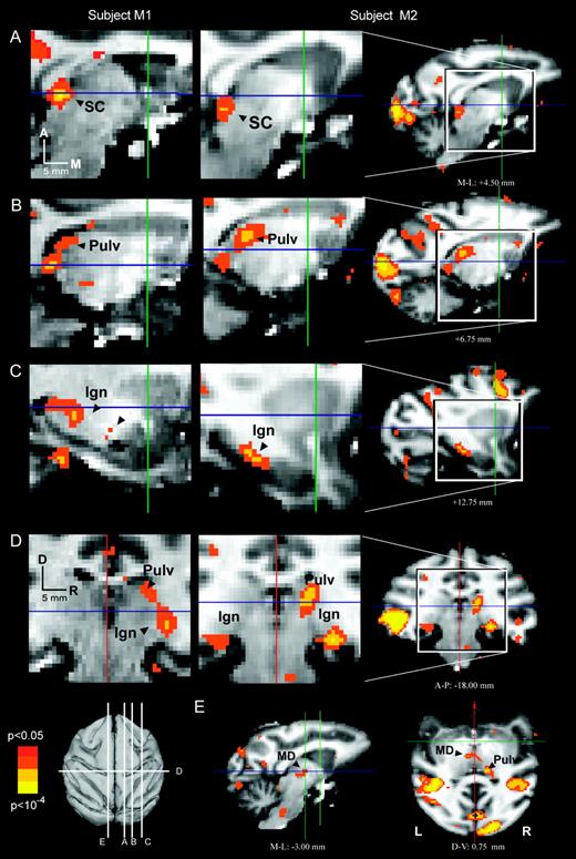 Subcortical summary. Subcortical activations (P < 0.05) from each subject (M1, first column; M2, second column) are color-coded for statistical significance and superimposed on the corresponding anatomical images from that subject. Note that coronal and transverse sections (panels D and E) use the neurological convention, with the right side of the illustrations representing the right side of the subject. Coordinates and magnitudes of activations that survived the group analysis appear in Table 1.