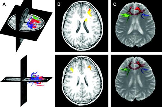 Frontostriatal fiber tracking results. (A) Three-dimensional rendering of frontostriatal fiber tracts superimposed on T1-weighted anatomical images for a typical subject. Blue, green and red tracts are derived from seed points in the right lateral, left lateral and medial prefrontal cortex, respectively. (B) Functional MRI activations from a separate study employing the go/no-go task used here superimposed on representative T1-weighted axial slices for a typical subject. These activations motivated seed point selection and are adjacent to the tracts represented in (C). (C) Frontostriatal fiber tracts cross-registered with semitransparent T2-weighted echo planar images for the same subject. Voxels through which the fiber tracts pass are highlighted in each slice, emphasizing the proximity to the cortical regions defined in (B).