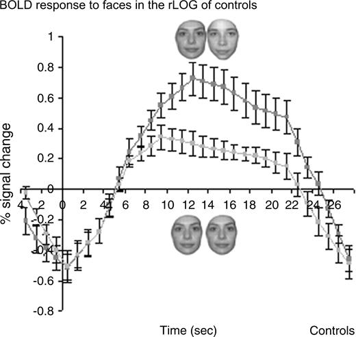 Recovery from fMR adaptation to individual faces in the right IOG of normal controls in experiment 1 (block design). A significant recovery from fMR adaptation to facial identity is observed in the right IOG of control subjects (n = 12; three runs averaged for each subject), a region that is structurally damaged in P.S.