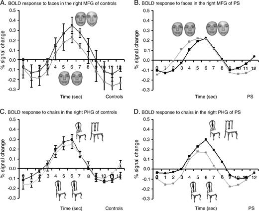 Recovery from fMR adaptation in the right MFG and PHG in experiment 2 (event-related design). (a) The average percent signal change (±SE) from baseline fixation is plotted for the ‘different faces’ and the ‘same faces’ conditions in controls (n = 7) and (b) in P.S. Reduced response in the rMFG of P.S. to trials with different faces reveal an abnormal neuronal processing of facial identity in the rMFG of the prosopagnosic patient. Trial starts at time = 0 s. The event-related BOLD response in trials with identical faces was normal in P.S. compared to the controls. Note that the event-related hemodynamic response appears to start and peak earlier in this condition for P.S. as compared to the group of controls, but this was not systematic, i.e. observed in only half of the subjects. The average percent signal change (±SE) in the rPHG to trials with different and identical chairs did not differ significantly in (c) normal controls and (d) P.S.