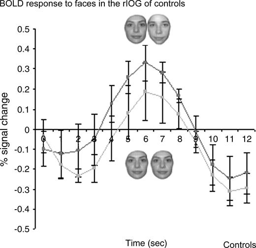 Recovery from fMR adaptation to individual faces in the rIOG of normal controls in experiment 2 (event-related design). A significant recovery from fMR adaptation to facial identity is observed in the rIOG of control subjects, a region that is structurally damaged in P.S.
