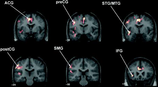 Two-operand math task: between-group contrast demonstrating significantly greater activation in the TS group compared with controls in anterior cingulate (ACG); left precentral gyrus (preCG) extending into postcentral (postCG) and supramarginal gyri (SMG); left superior temporal gyrus (STG) extending into middle temporal (MTG) and inferior frontal gyri (IFG). The control minus TS contrast for two-operand math was not significant.