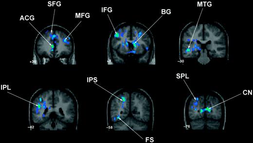 Three-operand math: between-group contrast demonstrating significantly greater activation in controls compared with the TS group in left inferior parietal lobe (IPL) extending into intraparietal sulcus (IPS), superior parietal lobule (SPL), fusiform (FS) and posterior middle temporal gyrus (MTG); anterior cingulate (ACG) extending into bilateral medial superior frontal gyrus (SFG); bilateral middle (MFG) and inferior frontal (IFG) gyri; cuneus (CN) and basal ganglia (BG). (b) Surface renderings of these results. The TS minus control contrast for three-operand math was not significant.