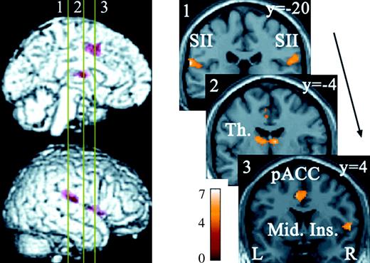 Brain regions commonly activated by C and Aδ nociceptor stimulation. Numbered bars in the left panel indicate locations of coronal slices in the right panel. Activated regions overlaid on an anatomically normalized MRI (MNI template) with their corresponding y coordinates (right side). SII = secondary somatosensory cortex, Th. = thalamus, pACC = posterior portion of the anterior cingulate cortex, Mid. Ins. = middle insula. MNI coordinates in Table 1.