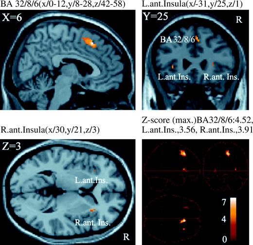 Brain regions differentially activated by C nociceptor stimulation. The activity in these areas was significantly stronger following the stimulation of C nociceptors than Aδ nociceptors (P < 0.001, uncorrected) and overlaid on an anatomically normalized MRI (MNI template). BA = Brodmann's area, Ant. Ins. = anterior insula, L. = left, R. = right. MNI coordinates in Table 2.