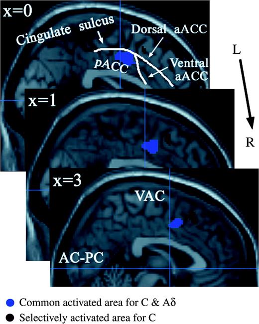 Activations in the ACC and pre-SMA overlaid on an anatomically normalized MRI (MNI template). These are shown from left (top part of the image) to right (bottom part of the image) with their corresponding MNI template x coordinates. The blue vertical line indicates the line through the anterior commissure (VAC). aACC = anterior portion of the anterior cingulate cortex, pACC = posterior portion of the anterior cingulate cortex.