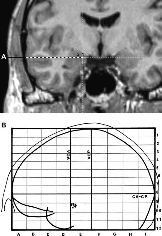 (a) Reconstruction of the amygdala electrode route in the MRI (patient TF). The stimulations were applied in the 2 most internal contacts (within the amygdalae) of the electrode (labeled 1 and 2). (b) Representation of the placement of the electrodes from the 8 patients exploring the amygdala. Right and left electrode positions are projected on a lateral view of the left hemisphere normalized in the proportional stereotactic grid system of Talairach and Tournoux. CA–CP, anterior commissure–posterior commissure plane; VCA, vertical plane through CA; VCP, vertical plane through CP.