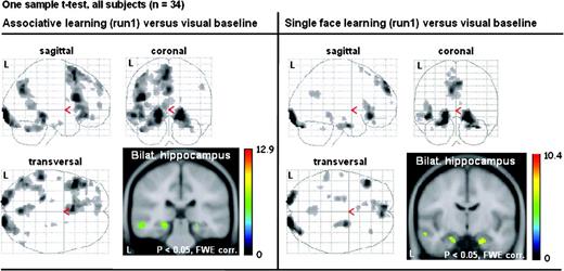 Learning-related brain activity in all 34 subjects (all APOE groups). Displayed are sagittal, coronal, and horizontal SPM2 through projections of brain regions that exhibited a significant activation during the first run of associative learning (left side) and the first run of single-face learning (right side), each compared with the visual baseline task. Bilateral hippocampal activity is displayed as color-coded statistical parametric t-map on Montreal Neurological Institute anatomical template.