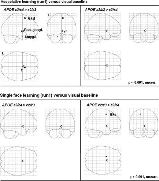 Comparisons between APOE ε3/ε4 and APOE ε2/ε3 carriers during the first associative learning run (upper panel) and during the first single-face learning run (lower panel), each versus the visual baseline task. Activity differences between APOE groups are shown as SPM2 through projections of brain regions in sagittal, coronal, and horizontal views. GFd, medial frontal gyrus; Bas. gangl., basal ganglia; Amygd., amygdala; GFs, superior frontal gyrus.