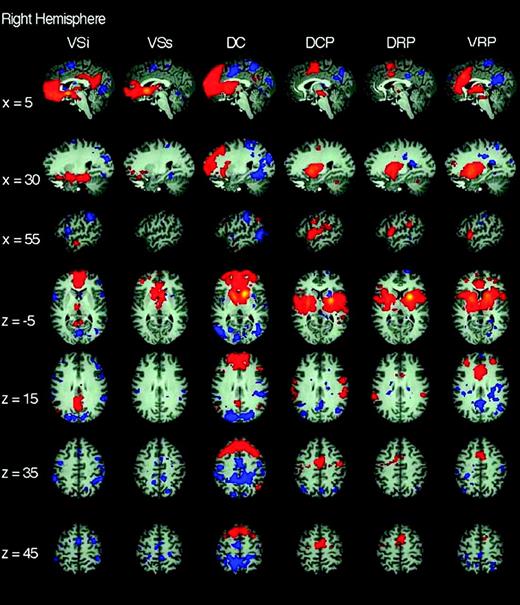 Functional connectivity of right hemisphere striatal seeds. Pattern of significantly positive (red) and negative (blue) relationships for right VSi (x = 9, y = 9, z = −8), VSs (x = 10, y = 15, z = 0), DC (x = 13, y = 15, z = 9), DCP (x = 28, y = 1, z = 3), DRP (x = 25, y = 8, z = 6), and VRP (x = 20, y = 12, z = −3), from left to right columns, respectively (Z score > |3.1|, cluster significance: P < 0.01, corrected). The 1st 3 rows are sagittal views (at x = 5, 30, and 55 from top to bottom, respectively), the last 4 rows are axial views (at z = −5, 15, 35, 45 from top to bottom, respectively). See text for details.
