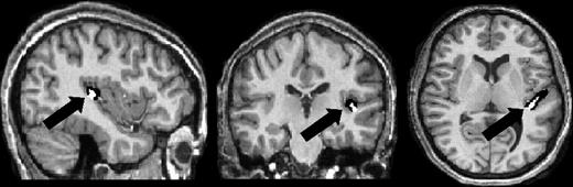 Gray (Black) and white (white) matter within HG of a representative subject shown on sagittal (left), coronal (middle), and axial (right) planes.