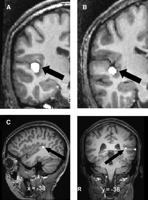 White label shows left HG label from (A) a representative successful learner and (B) a representative less successful learner. Panel (C) shows activation (in white) bordering HG after training in the successful versus less successful learners contrast. Activation (single-voxel t = 3.3, P < 0.001) is projected onto the brain of one subject for visual clarity (for details see Wong et al., forthcoming).