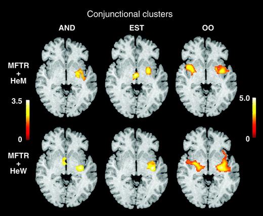 Common activations between the groups. Shown are conjuctional clusters in different groups of subjects, superimposed on the standard brain. All images show horizontal level at Z = −5 according to Talairach’s atlas. The Sokoloff’s color scale illustrates Z values (0.0–3.5 for AND and EST and 0.0–5.0 for OO). The OO clusters were large and covered several lower sections. Because the same brain section is chosen, figures do not always illustrate maximal activation for each condition. Subject’s right side is to the right.
